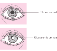 Ulcera-corneal