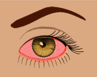 Uveitis