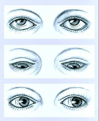 nystagmus