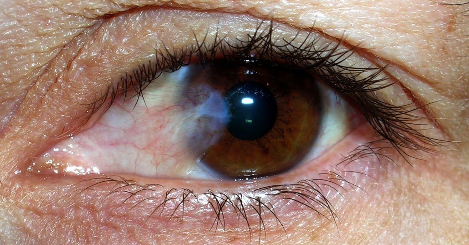 cataratas