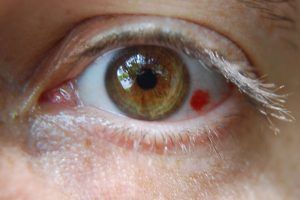 hemorragiasubconjuntiva